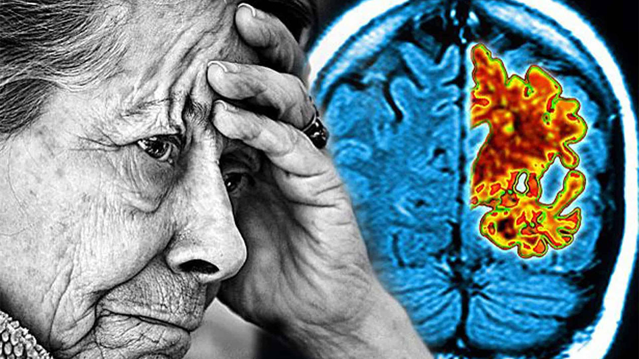 Alzheimer Hastalığı her geçen yıl artıyor!