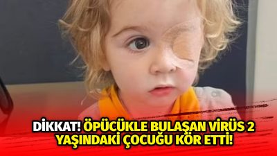 İngiltere’de yaşayan 2 yaşındaki Juwan, bir yakınının kendisini öpmesiyle herpes