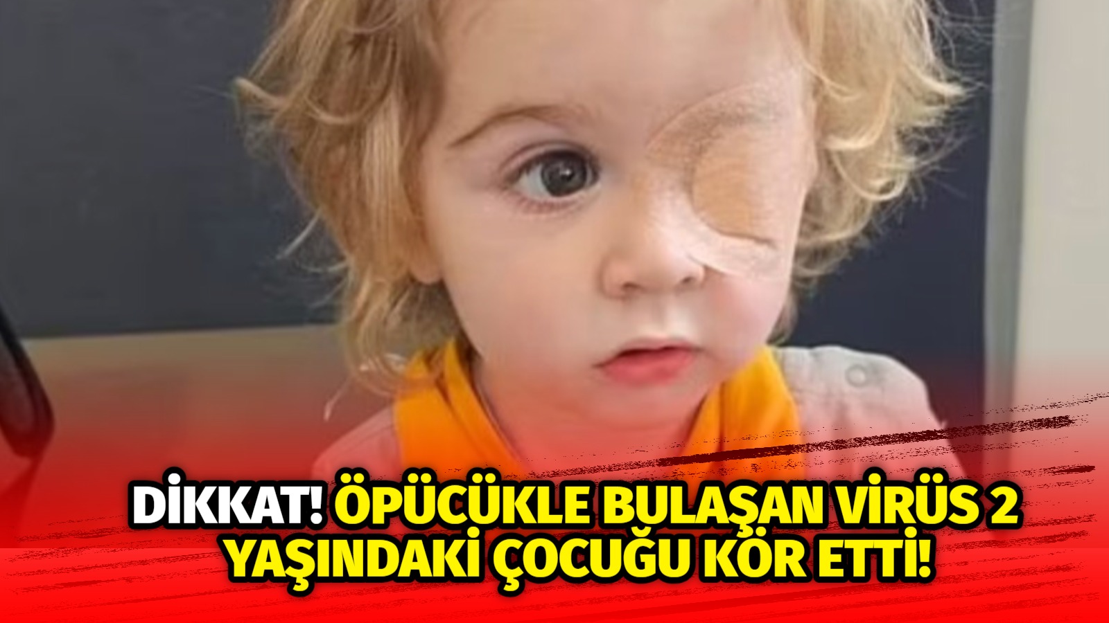 Dikkat! Öpücükle bulaşan virüs 2 yaşındaki çocuğu kör etti!