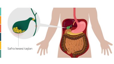 Özel İnova Hastanesi Genel Cerrahı Op. Dr. Erdal Gören, safra