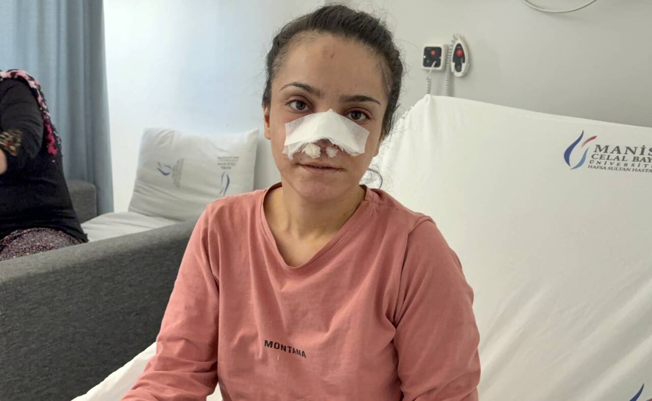 Manisa'nın Turgutlu ilçesinde eşi tarafından darp edilerek burnu ısırılıp koparılan